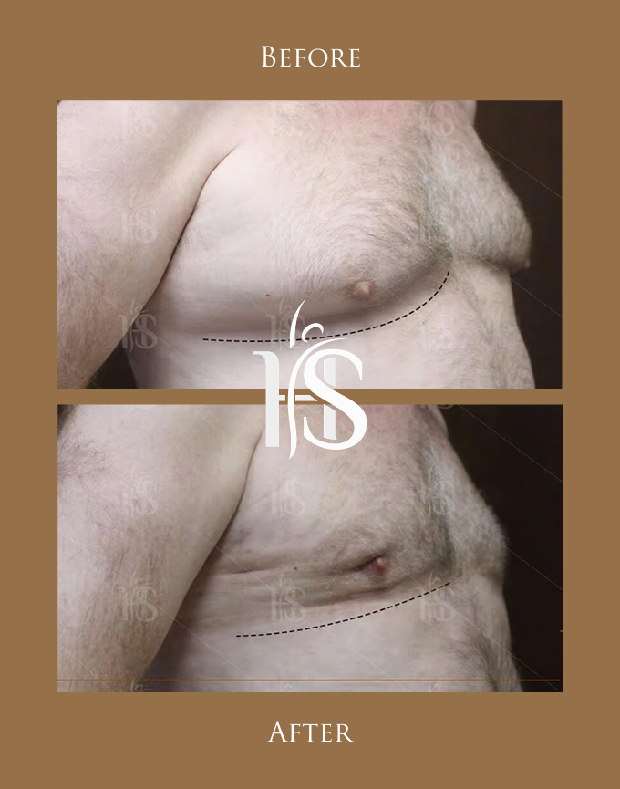 التثدي عند الرجال