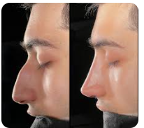 قبل وبعد عملية تجميل الانف مع أفضل دكتور تجميل أنف في الرياض