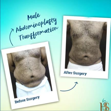 صور قبل وبعد عملية شد البطن في الرياض