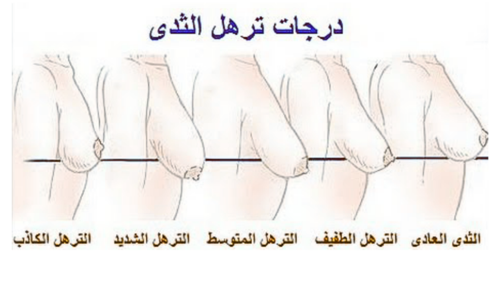 شكل توضيحي يوضح درجات ترهل الثدي بالصور