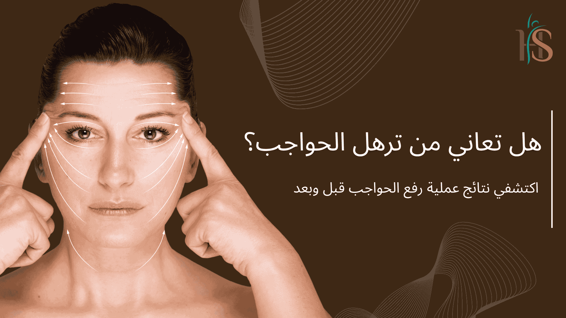 نتائج عملية رفع الحواجب قبل وبعد