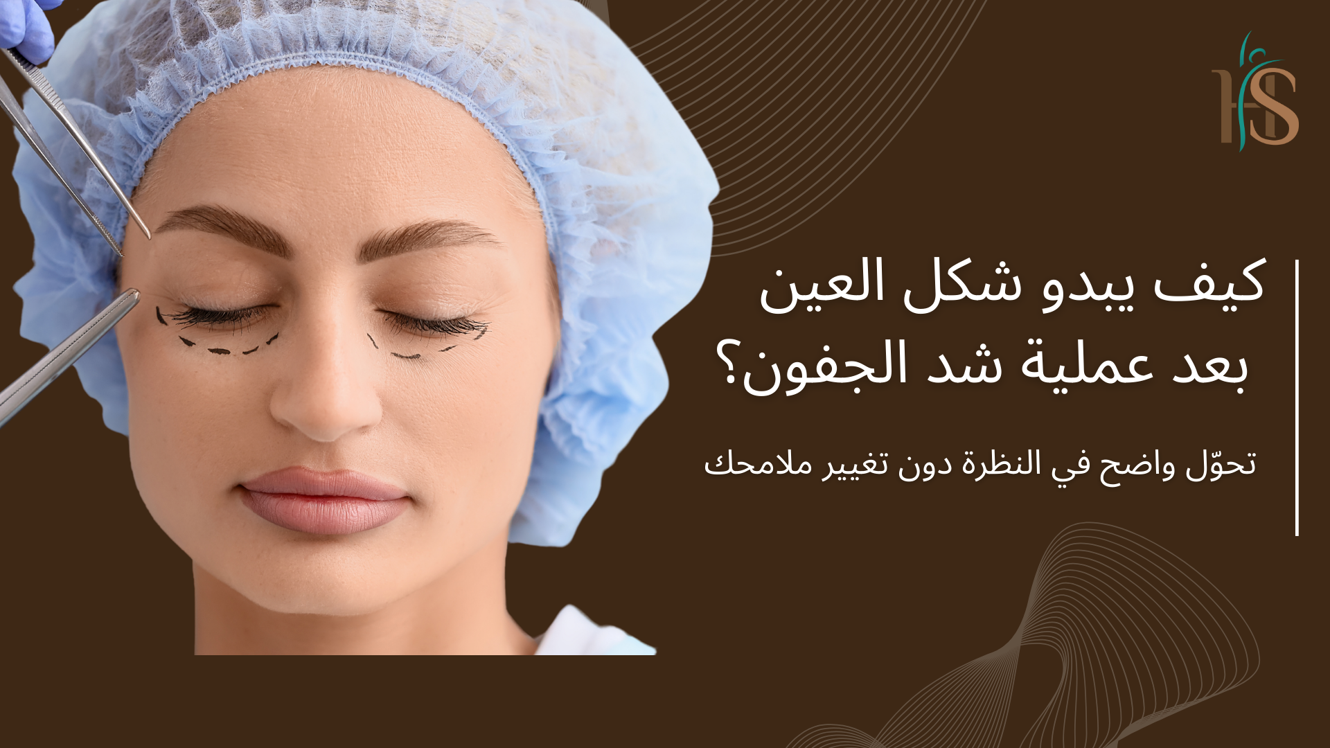 كيف يبدو شكل العين بعد عملية شد الجفون؟ تحوّل واضح في النظرة دون تغيير ملامحك