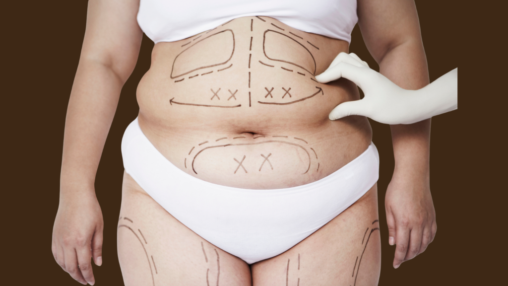 تكلفة عملية شفط الدهون في الرياض