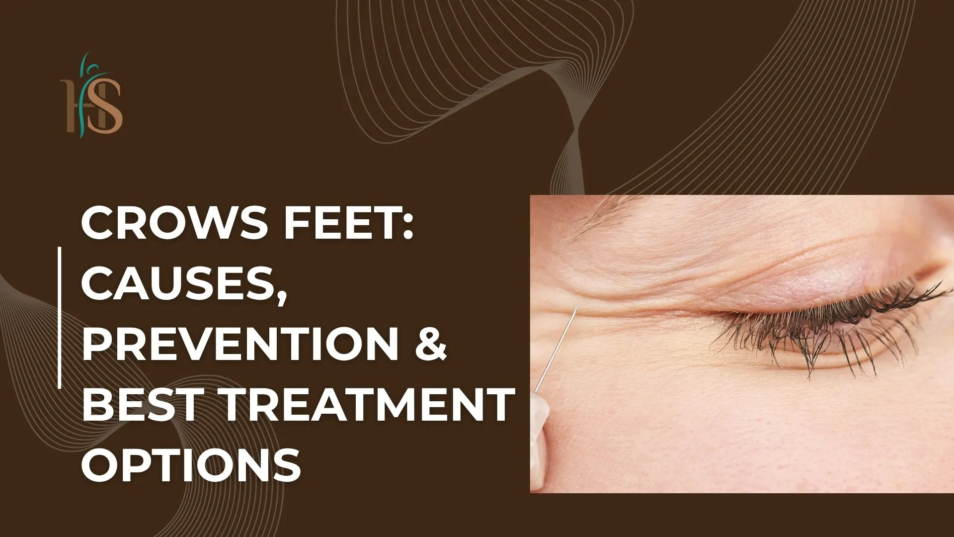 Crows Feet